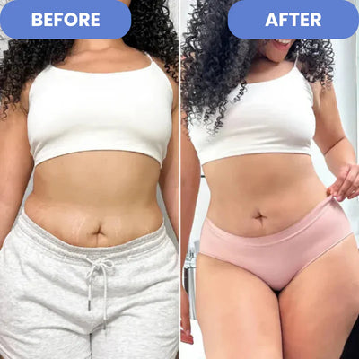 SculptEase™ |  Cellulitisbehandeling 4-in-1