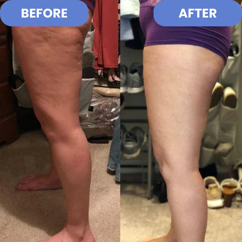 SculptEase™ |  Cellulitisbehandeling 4-in-1
