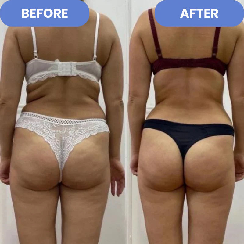 SculptEase™ |  Cellulitisbehandeling 4-in-1