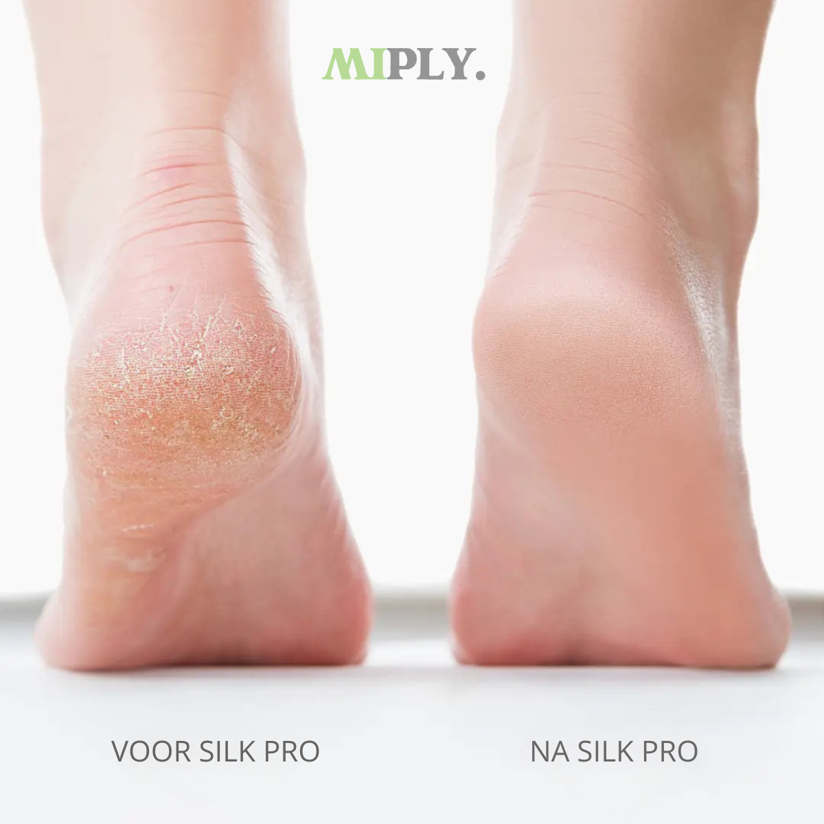 Silk Pro™ – Zachte voeten in minuten, zonder salonbezoek (inclusief 4 gratis rollers)
